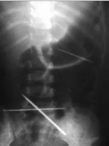 Figure 1 - Abdomen X-ray showing three metallic objects