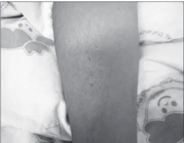 Figure 2 - Petechiae on the right forearmFigure 1 - Cluster of petechiae on the right cervical region