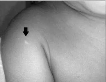 Figure 1 - Papular lesion on the right shoulder (Case 1)