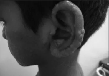 Figure 3 - Iniltration and lepromas on the auricle (Case 2)