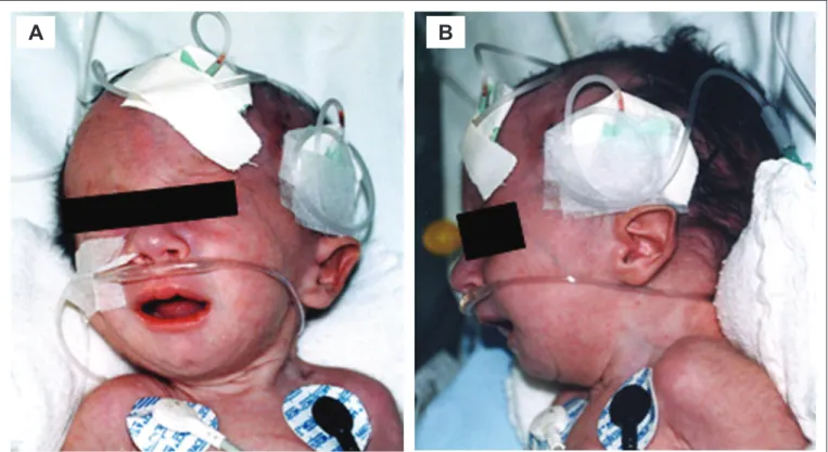 Figure 1 - Craniofacial indings of a patient with Edwards’ syndrome in the study sample