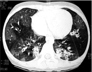 Figure 3 - High-resolution chest perfusion tomographic shows  total  pulmonary  atelectasis  on  the  right  and  destruction  of  pulmonary parenchyma; hyperinlated left lung, mosaic pattern  of perfusion areas and bronchial wall thickening