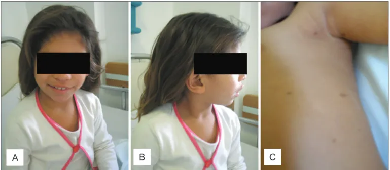 Figure 1 - Patient at 4 years and 6 months (A, B and C). Note especially café-au-lait spots and axillary freckles (C)