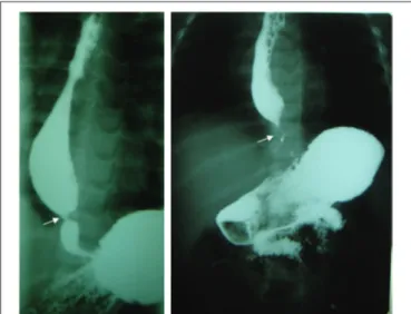 Figure 2 - Rigid circular distal ring (R), suggestive of choristoma. 