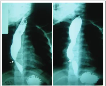 Figure 4 - Stenosis (arrow) over the lower third of the esophagus  (case 4)