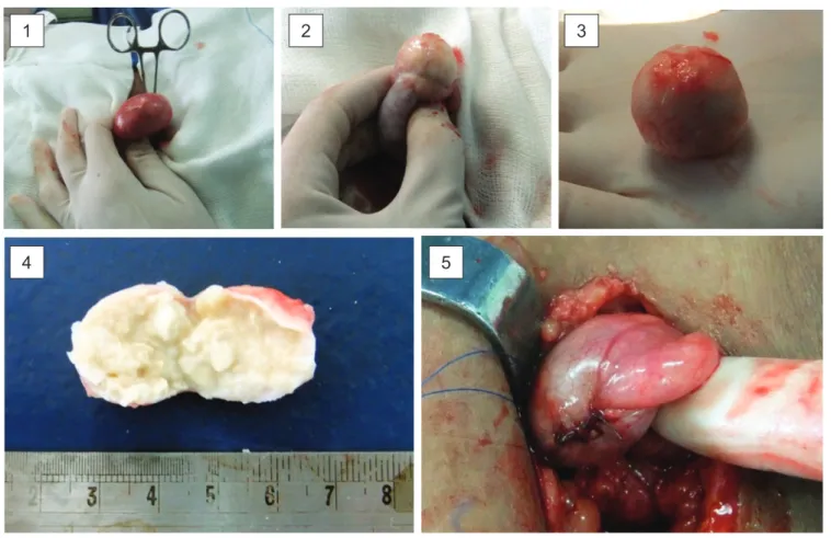 Figure 2 - Testis exposed; (2) Tumor exposed; (3 and 4) Macroscopic aspect of the tumor; (5) Testis reconstructed