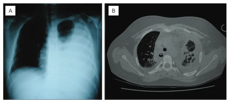 Figure 1 - (A) Chest radiograph on admission homogenous opacity on the left side up to the apex, opaciication of costophrenic and  cardiophrenic sinuses, with the presence of mild deviation of the contralateral mediastinum