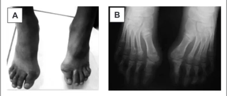 Figure 2 - A. Multiple painless and immovable swellings of  stony consistency. B. Radiographic image (posteroanterior view)  showing soft tissue heterotopic ossiication, predominantly on  Figure 1 - A