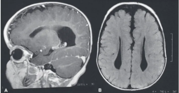 Fig. 1  TSkull computed tomography. (A) Sagittal view  showing the corpus callosum agenesis and hypoplasia of the  cerebellar vermis; (B) Cross-sectional view showing  hypoplasia of the vermis and lateral ventricles