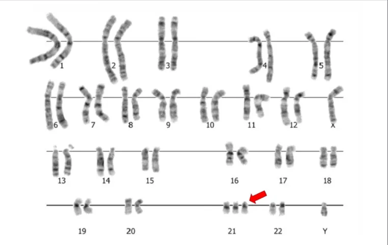Figure 1 - karyotype by GTG-banding (trypsin-Giemsa G-band) showing full trisomy of chromosome 21, compatible with Down  syndrome