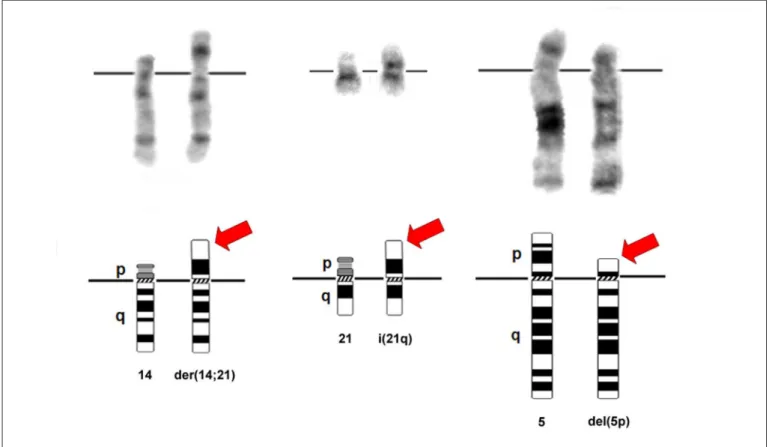 Figure 2 - Partial karyotype by GTG-banding (trypsin-Giemsa G-band) and ideograms showing, respectively, a Robertsonian  translocation between chromosomes 14 and 21 [der(14;21)], one isochromosome of the long arm (q) of chromosome 21 [i(21q)] 