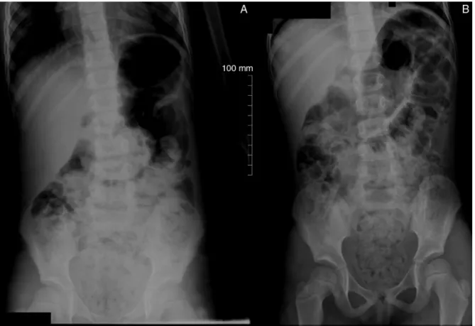 Figure 1 Abdominal X-rays in the standing (A) and supine (B) position, disclosing large amount of stool in the ascending and descending colon, sigmoid and rectum