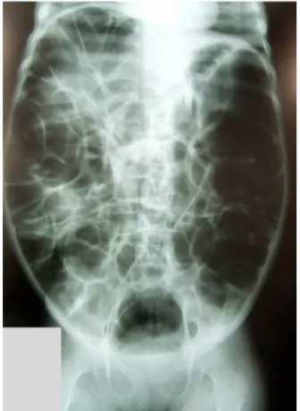 Figure 2 Diffuse and severe gas distension, attaining small intestine and colon.