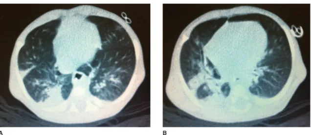 Figure 1  Pulmonary computer scanner images. A. Reveals several bands of atelectasis with bronchiectasis and some bronchi  with thickened walls