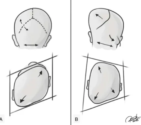 Figure 2 Representation of positional plagiocephaly and true (synostotic) posterior plagiocephaly