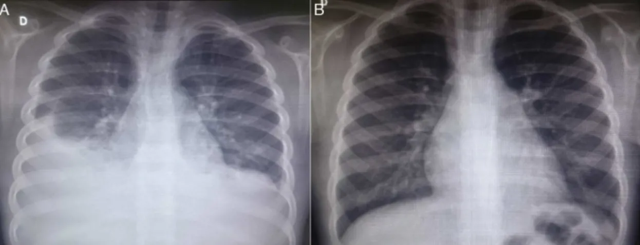 Figure 1 Chest radiography images of the patient in the posteroanterior view; A---at patient admission, costophrenic sinus oblit- oblit-eration is observed bilaterally, with pleuropulmonary opacity to the right; B---six months after discharge, during an ou