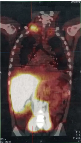 Figure 2 SPECT/CT image of the cervicothoracic and abdom- abdom-inal regions obtained from the lymphoscintigraphy assessment with intradermal administration of dextran-99mTc on the  dor-sum of the feet; the images obtained 18hours after start of the examin