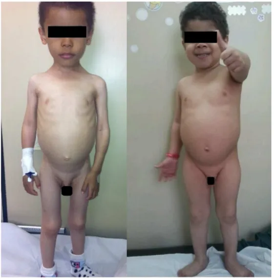 Figure 3 Patient 1 at the first consultation and 2 months later.