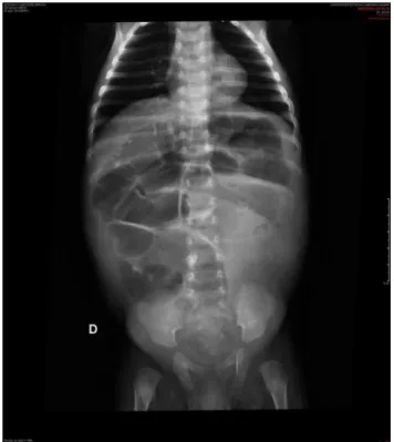Figure 1 Simple abdominal radiography of a 2-month-old patient with total colon aganglionosis