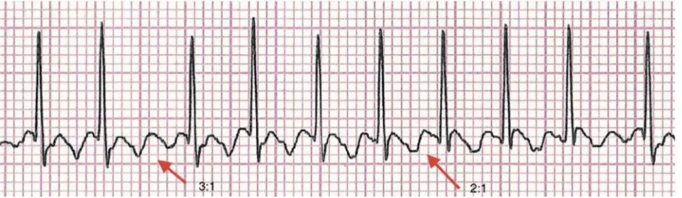 Figure 2 Electrocardiogram showing the ‘‘sawtooth’’ or ‘‘picket fence’’ pattern of atrial flutter, with 3:1 and 2:1 atrioventricular conduction in the D2 lead.