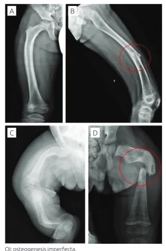 Figure 2 Radiographic indings of the lower limbs. (A  and B) Male patient with osteogenesis imperfecta  type 1 showing minor bowing of the right femur  and diaphyseal fracture of the left femur; (C) female  patient with osteogenesis imperfecta type 3 showi