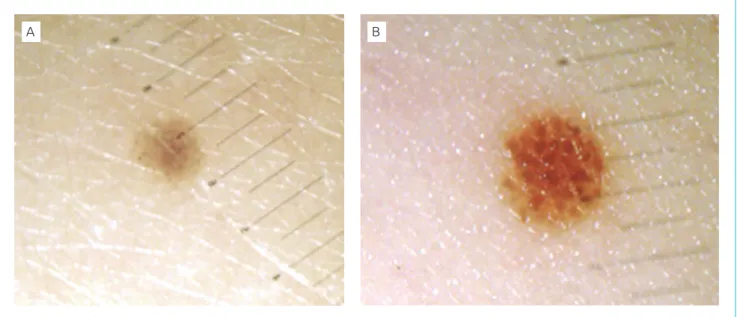 Figura 1 Dermatoscopia digital: (A) 1 mm em fevereiro de 2010; (B) 1,5 mm em março de 2011