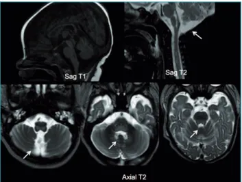 Figure 1 MRI: Sagittal T1, Sagittal T2 and Axial T2 views  showing well-deined hypointense (T1) and hyperintense  lesions (T2) at the dorsal portion of pons and bulb.