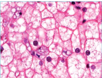 Figura 1 Esteatose microvesicular intense com deposição  focal de cristais de colesterol na célula Kupffer no  microscópio ótico.