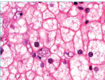 Figure 1 Intense microvesicular steatosis with focal  deposition of cholesterol crystals in Kupffer cell at  optical mycroscopy.