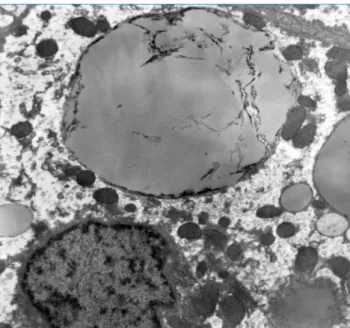 Figure 2 Triglyceride deposits were sometimes fragmented  with irregular striations. (“bitten-apple” aspect).