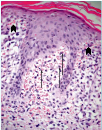 Figure 1 Erythematopurpuric and crusted papules on  the torso