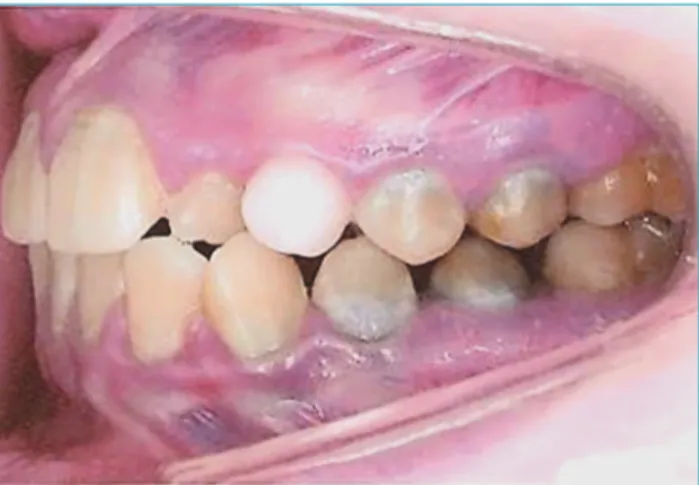 Figure 1 Intraoral view with prolonged retention of left  superior deciduous canine and greenish pigmentation  of teeth.