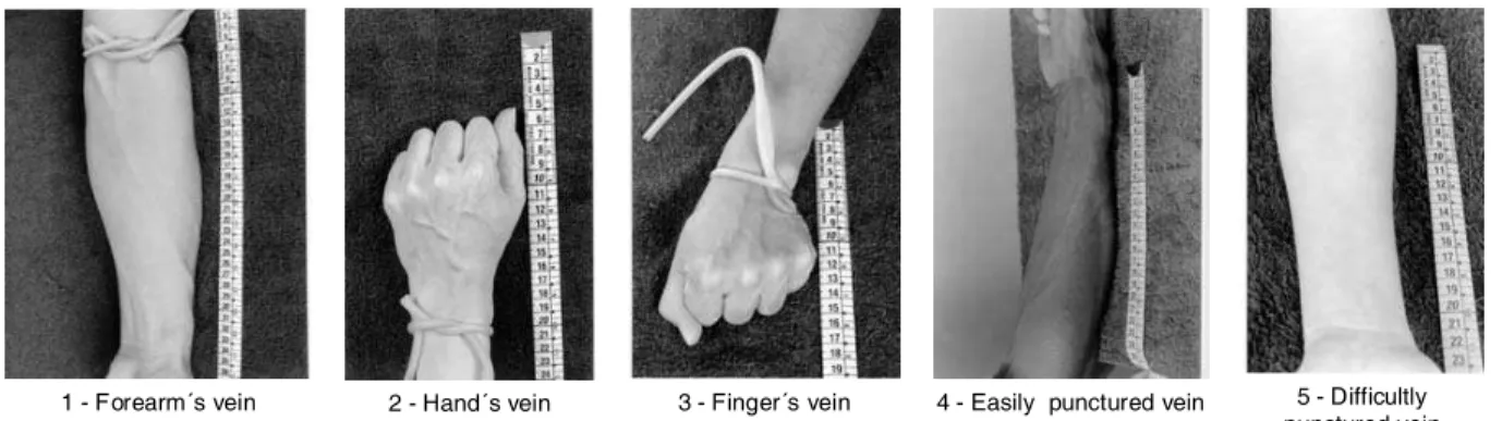 Figure 3 - Vein types. Examples of vein pictures classified according to the criteria: Location with reference to the anatomy structure (1, 2, 3); Puncture Easiness (4, 5)