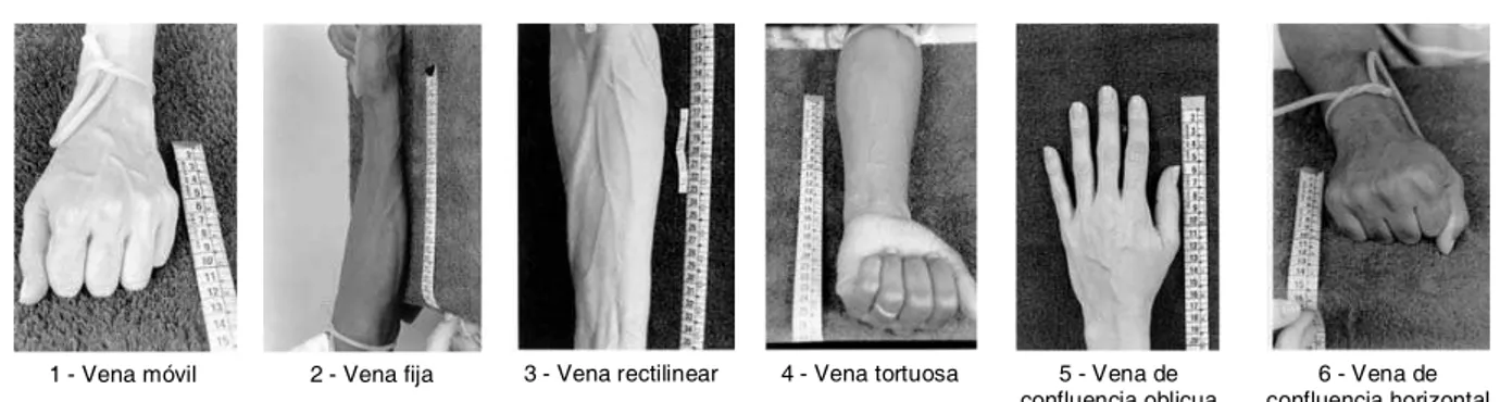 Figura 1 - Tipos de venas. Ejemplos de fotos de venas clasificadas de acuerdo con los criterios Movilidad (1,2), Trayecto (3,4) e Inserción/Derivación (5,6)