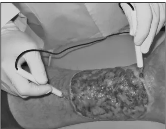Figure 2 – Microcurrent application to the ulcer