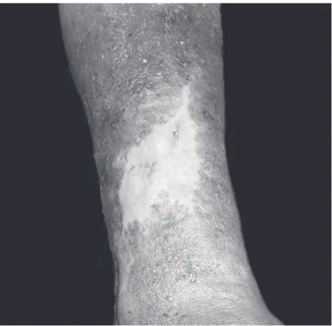 Figure 4 – Final phase of treatment using Ulmo honey and ascorbic acid of type 3 venous ulcer in a male patient