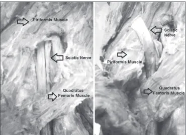 Figure 1 - A) The sciatic nerve emerges below the piriformis muscle  (“normal”); B) The sciatic nerve passes above the piriformis muscle  (“variation”).