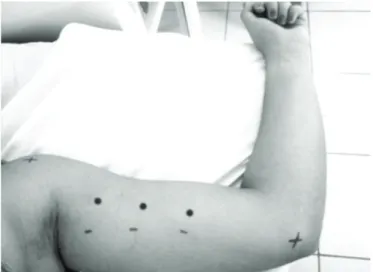 Figure 1 – Points to evaluate supericial sensitivity on the dermatome  of intercostobrachial sensory nerve (ICBN).