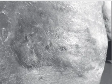 Figure 1 – Chronic herpes zoster lesion