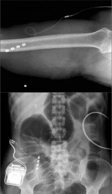 Figure 1. Example of plaque electrode model On-Point PNS (Medtro- (Medtro-nic) placement