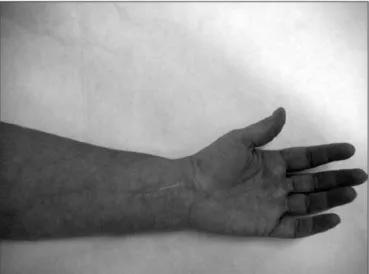 Figure 1. Needle inserted in the CS6 point (Neiguan)