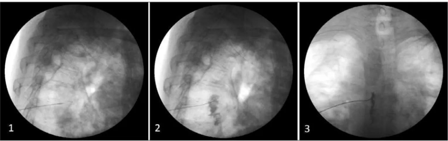 Figure 1 – Thoracic sympathetic chain block.