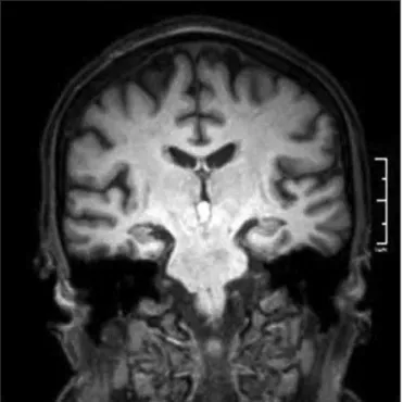 Figure 3. Weighted coronal resonance magnetic in T 1