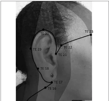 Figure 1. Triple energizer (TE) meridian and wrist ankle technique are- are-as represented at the side of the face
