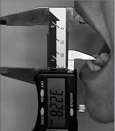 Figure 2. The needle was inserted 10mm anterior to the tragus and  2mm below the tragus line – external corner of the orbital cavity