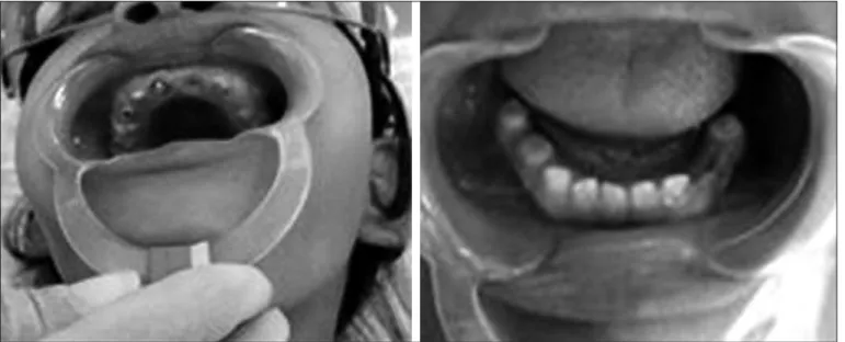 Figure 2. Panoramic X-rays showing lack of dental enamel or a thin  layer of it and the conirmation that both dentitions were affected by  the abnormality