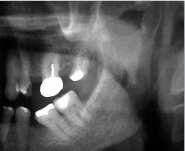Figure 2. Computerized tomography of temporomandibular joint  (open mouth)