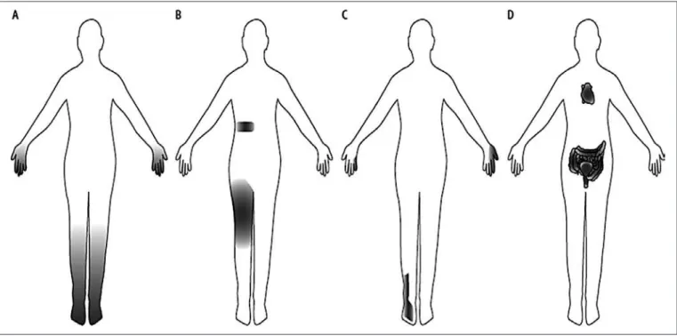 Figure 1. Schematic drawing – different clinical patterns of diabetic neuropathy. Modiied 20