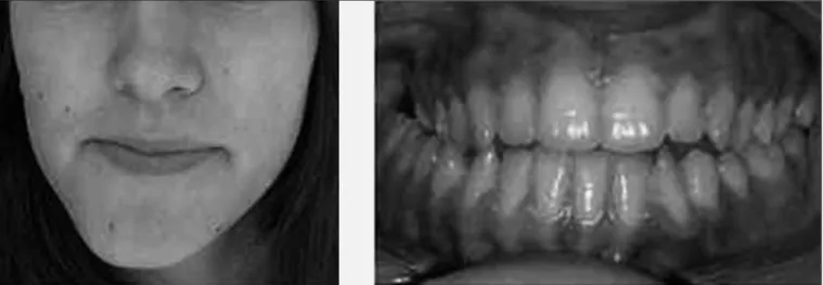 Figure 3. Tridimensional reconstruction of left mandibular con- con-dyle on cone beam computed tomography, where surgery was  performed