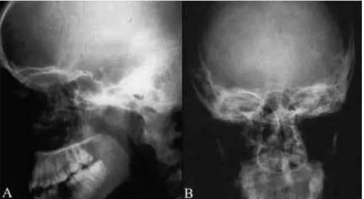 Figure 4. Lateral (A) and forward (B) radiographs post-surgical  Note the absence of the projectile.
